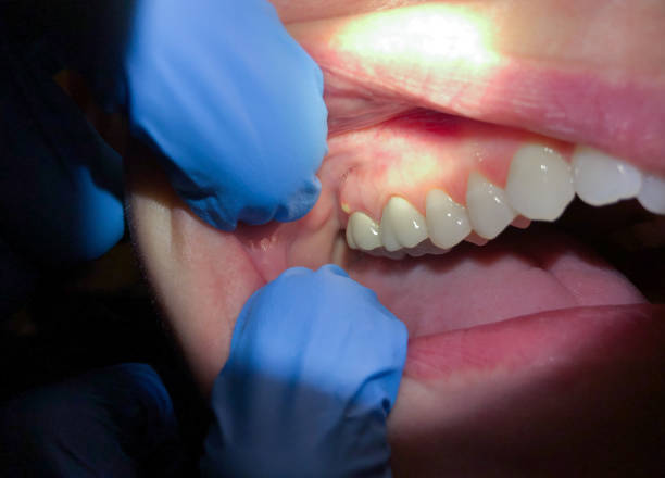 Tooth Infection Emergency Dentist in NJ